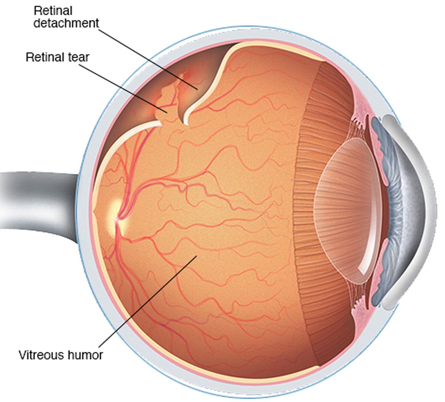 retinal-detachment.jpg