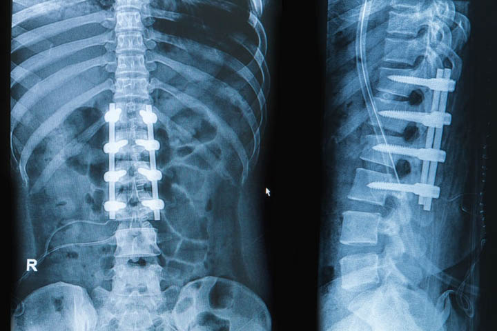 Example-Xray-4-Screws-L1-Bone.jpg