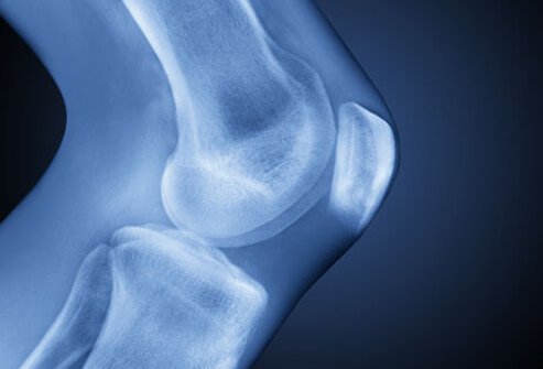 osteoarthritis-overview-s1-xray-knee.jpg