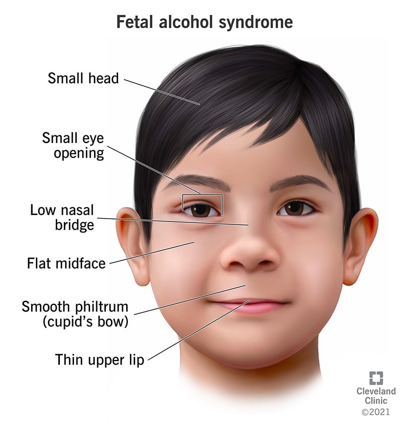 15677-fetal-alcohol-syndrome