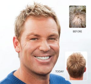 Shane-Warne-Hair-Loss-Treatment-Results-300x279.jpg