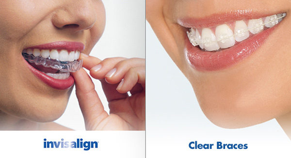 clear-braces-invisalign1.jpg