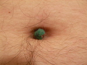 300px-Navel_lint_ball.jpg