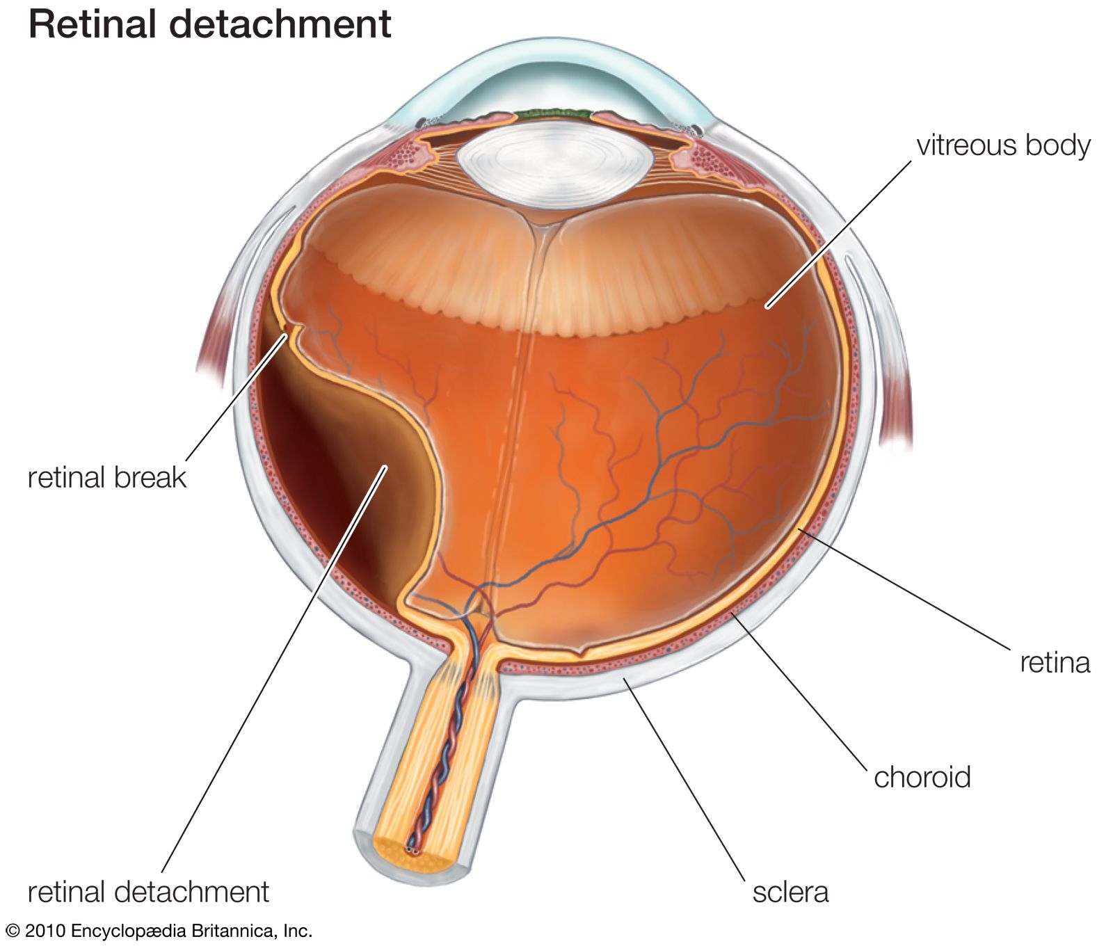 Retinal-detachment.jpg